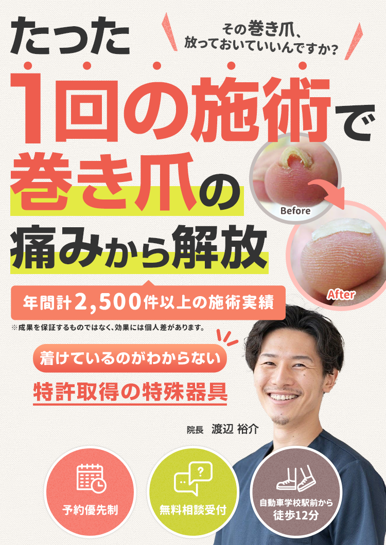 たった1回の施術で巻き爪の痛みから解放