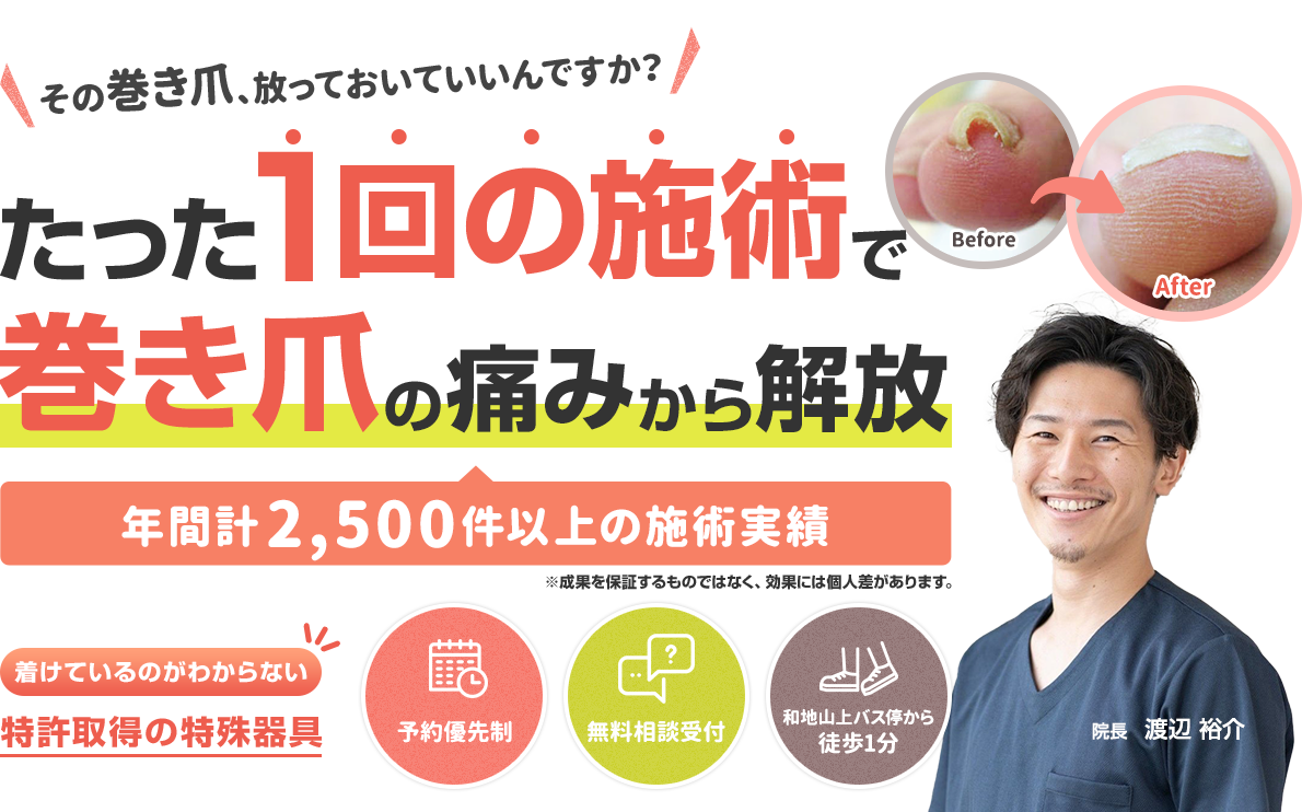 たった1回の施術で巻き爪の痛みから解放