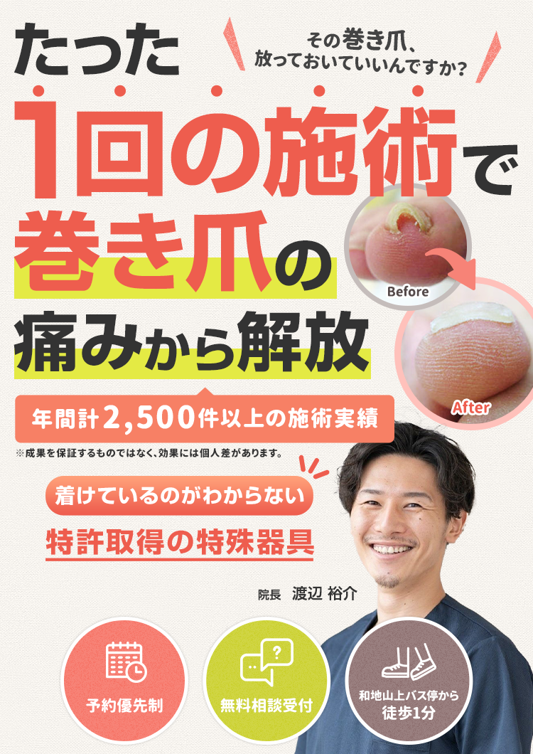 たった1回の施術で巻き爪の痛みから解放